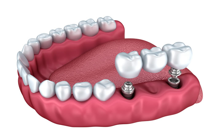 [تصویر:  protesis-sobre-implantes-dentales-barcelona.jpg]