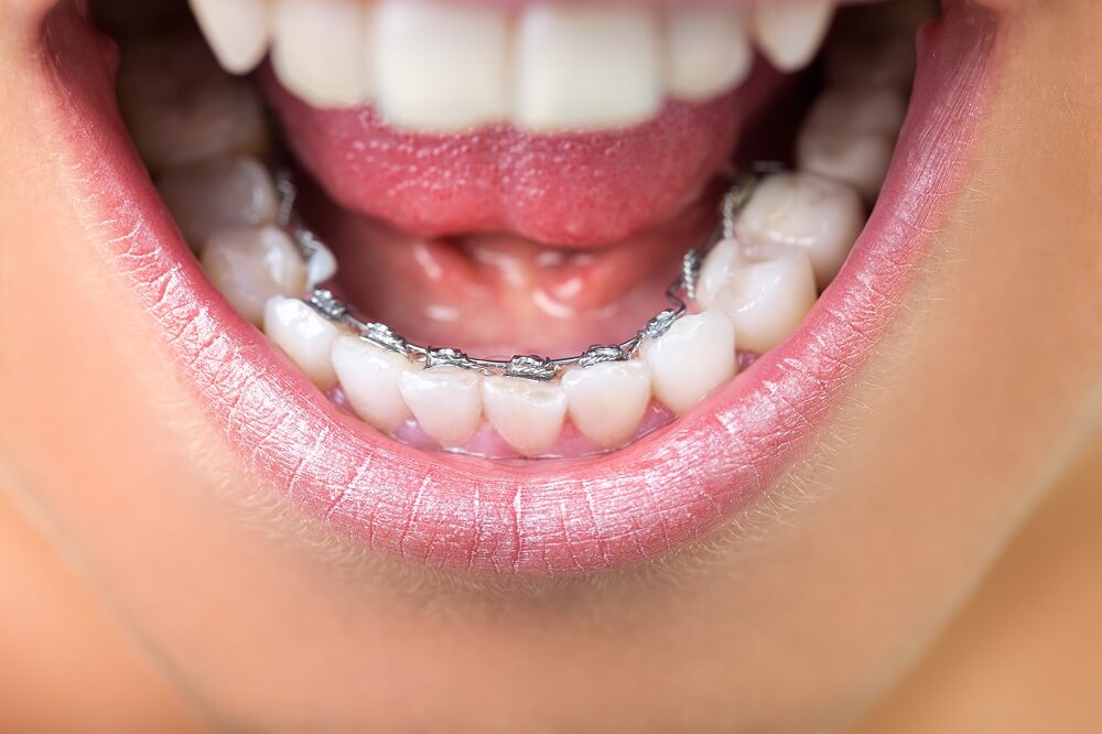 ortodoncia incognito detalle