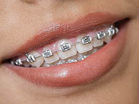 ortodoncia metálica