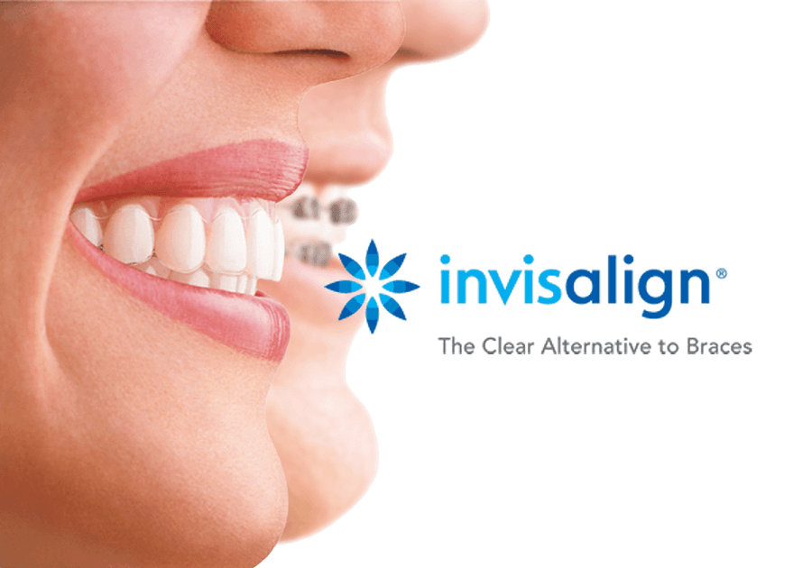 Ventajas De La Ortodoncia Invisalign | Clinica Beltrán Benifaió