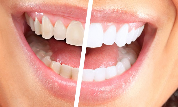 blanqueamiento dental comparación