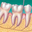 encias-periodontis