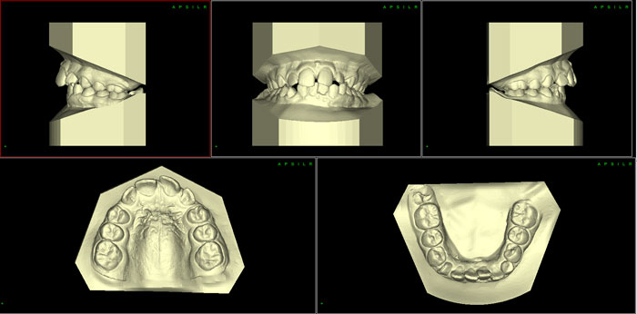 escaneado-de-modelos-fabian-ortodoncia-modelo
