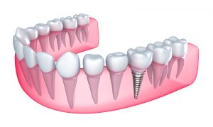 dental-implant-21