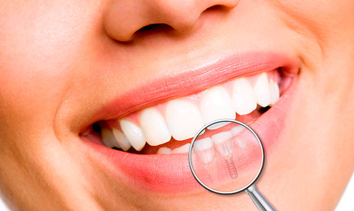 Implantes dentales cómo cuidar