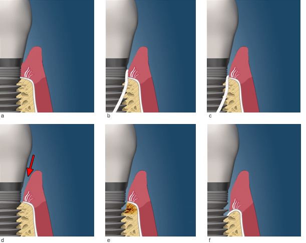 dental-implant-care4
