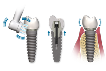 vibrating-tooth-brush-dental-implant