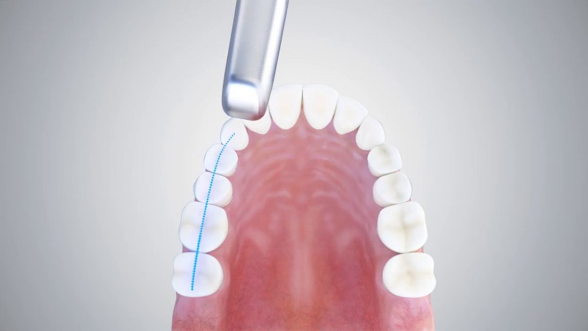 escáner intraoral